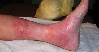 Stasis Dermatitis