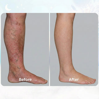 ORNEXIS - EMS TREAT STASIS DERMATITIS FROM HOME - Ornexis