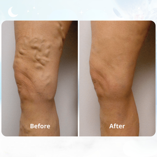 ORNEXIS - EMS FIX RESTLESS LEGS FROM HOME